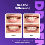 DRDENT Purple Teeth Whitening Strips – 7/21 Whitening Sessions – Non Sensitive Teeth Whitening – Peroxide-Free