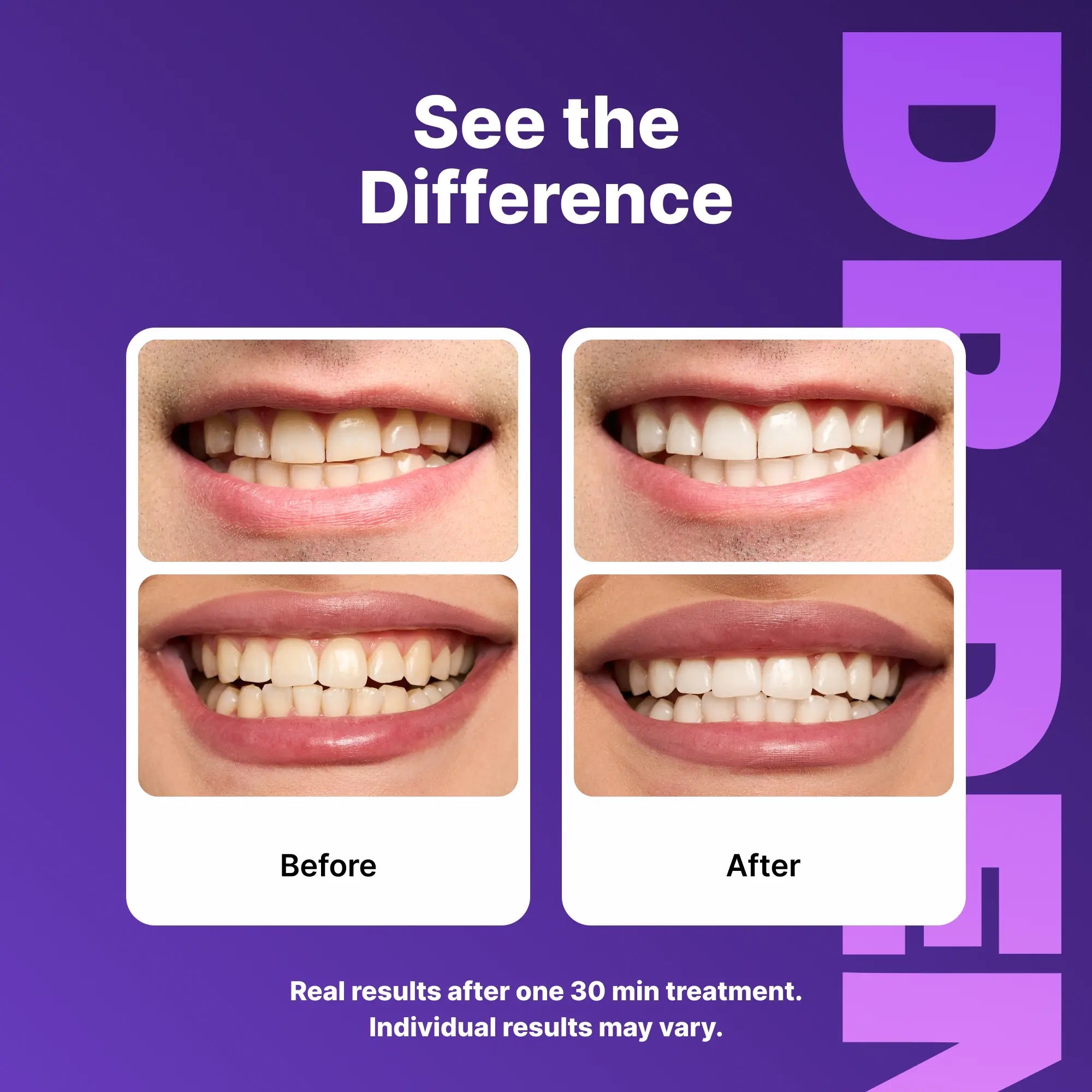 DRDENT Purple Teeth Whitening Strips – 7/21 Whitening Sessions – Non Sensitive Teeth Whitening – Peroxide-Free